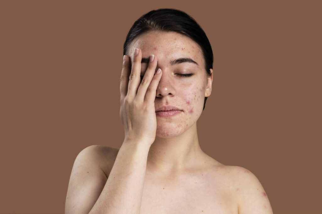 Woman with oily skin following a skincare routine for oily skin